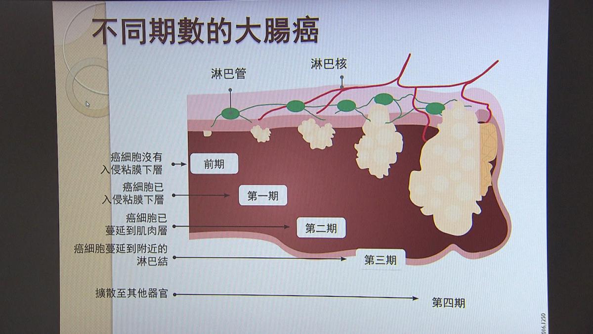 Picture_EP433 大腸癌_003.jpg