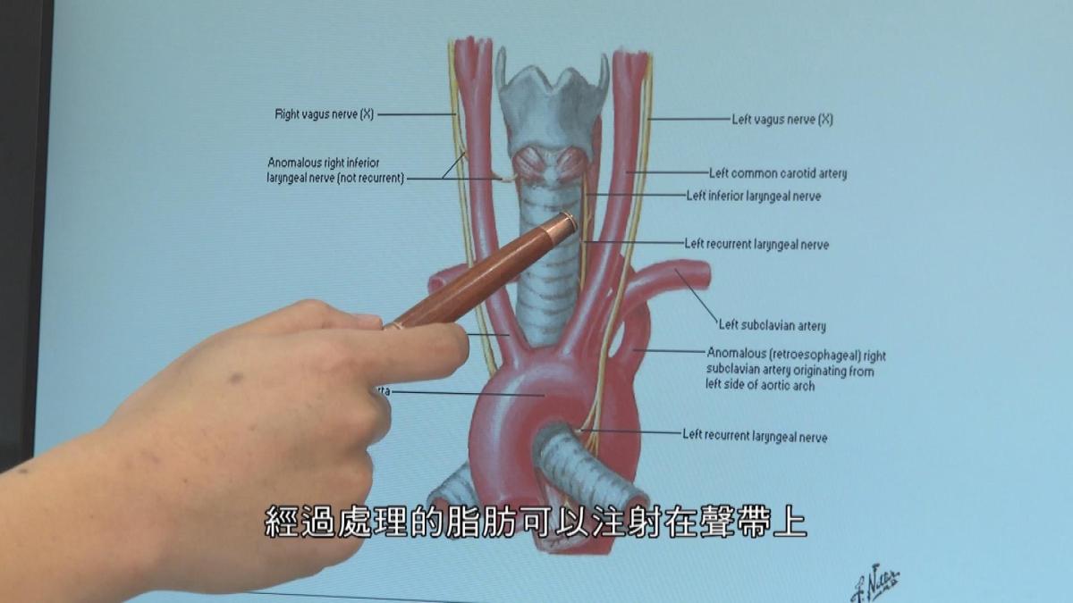 Picture_EP440 聲帶閉合不全 DOCTOR_003.jpg