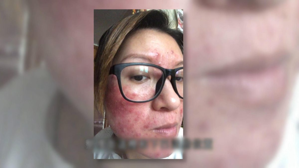 Picture_J.MEDIC.ACNE HOLD_001.jpg